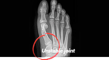 2d treament foot x-ray